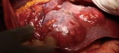 LIVER LEIOMYOSARCOMA