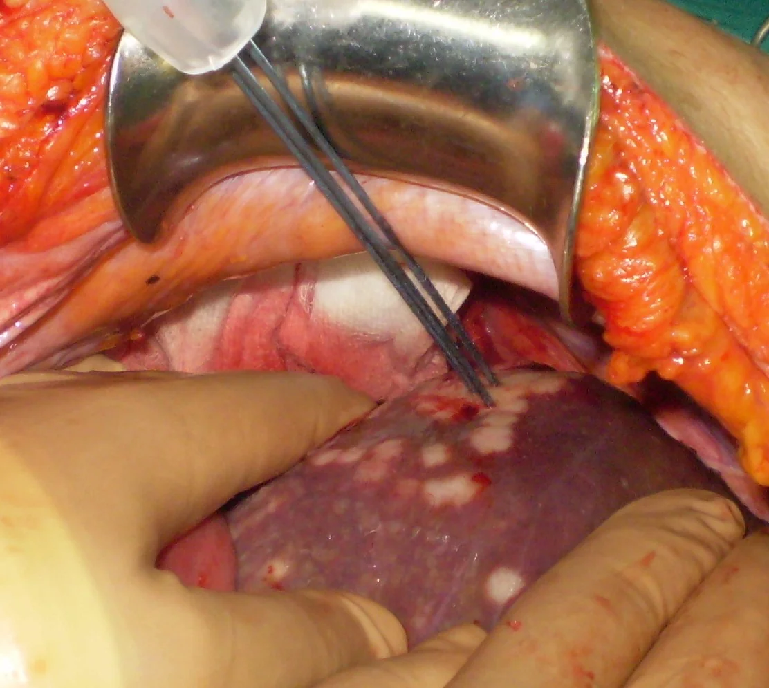 LIVER METASTASES - RF APPLICATION