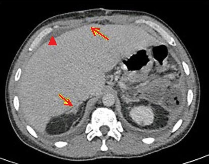 LIVER SARCOIDOSIS