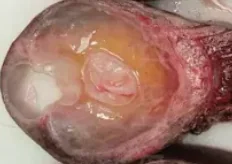 MESENCHYMAL HAMARTOMA