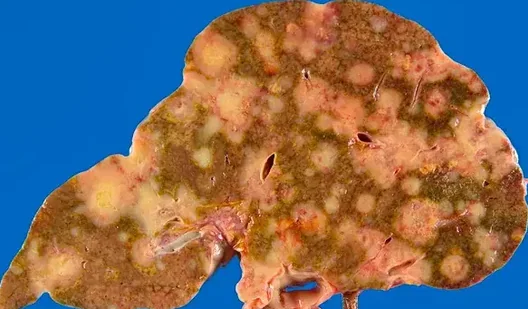METASTATIC BREAST CARCINOMA