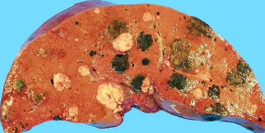 METASTATIC MALIGNANT MELANOMA