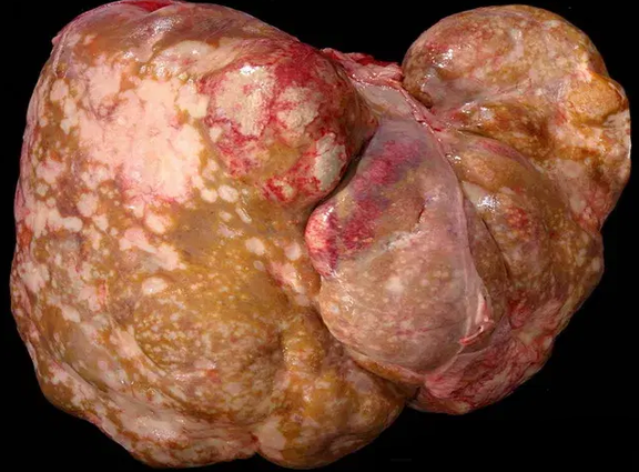METASTATIC NEUROENDOCRINE TUMOR