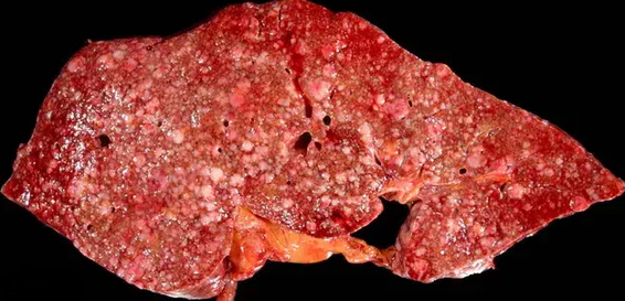 METASTATIC SMALL CELL CARCINOMA