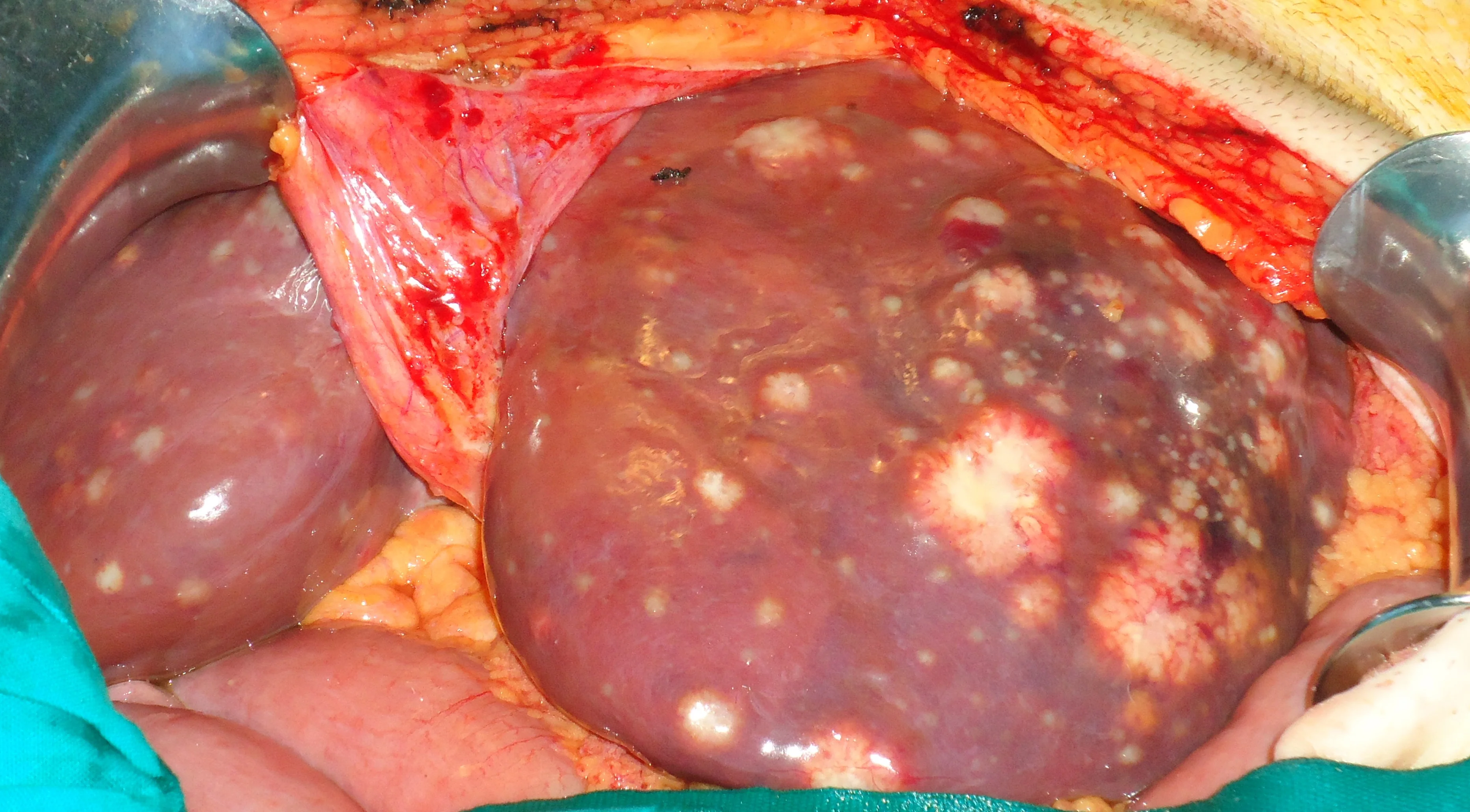 MULTIPLE LIVER METASTASES