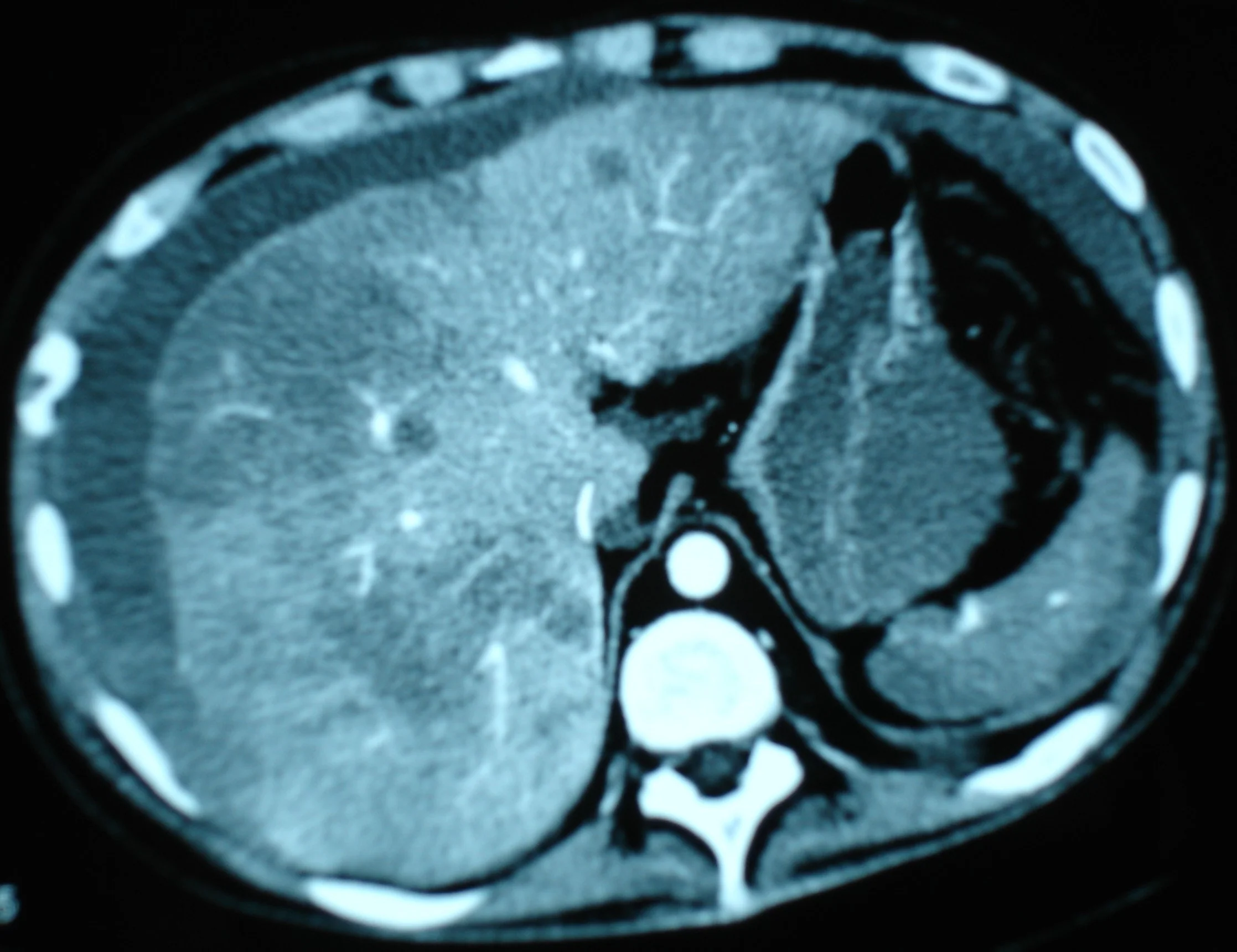 LIVER HODGKIN'S LYMPHOMA
