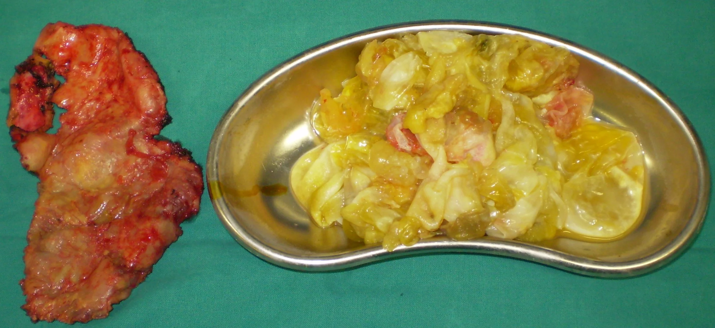 HYDATID CYST'S CONTENT