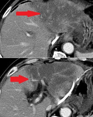 POST-PANCREATECTOMY LIVER NECROSIS