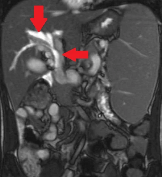 PORTAL BILIARY DUCTOPATHY