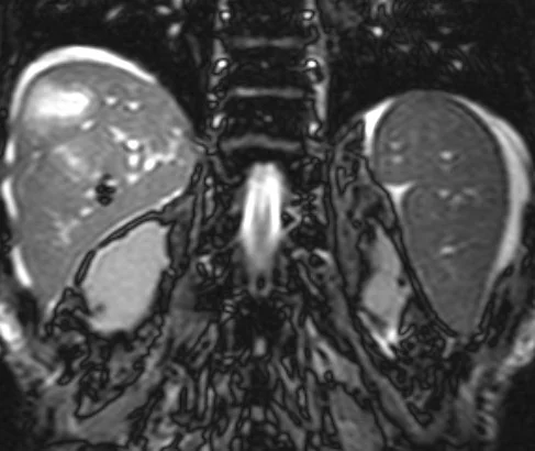 POST-OPERATIVE DEVELOPMENT OF LIVER ABSCESSES