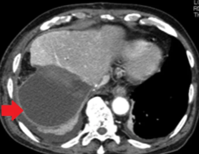 POST-HEPATECTOMY FLUID COLLECTION