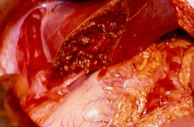 LIVER LACERATION