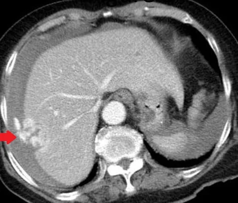 RUPTURED LIVER ANGIOSARCOMA