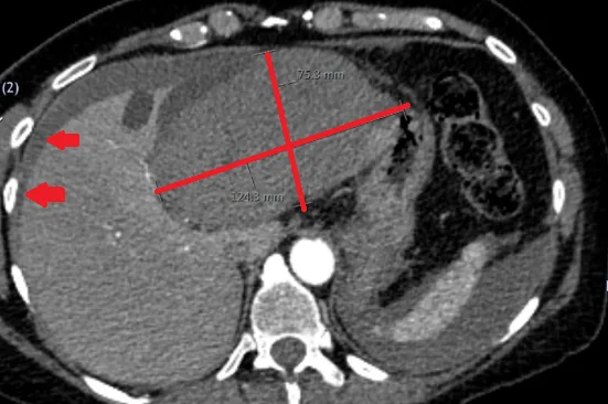 RUPTURED LIVER CYST