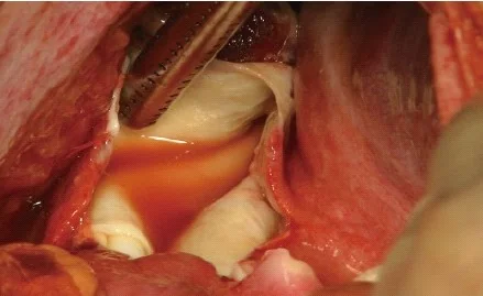 RUPTURED LIVER HYDATID CYST