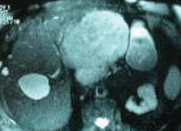 SOLITARY MALIGNANT FIBROUS LIVER TUMOR