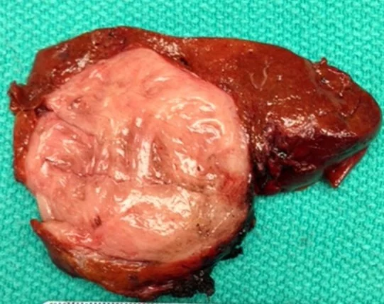 SOLITARY MALIGNANT FIBROUS LIVER TUMOR