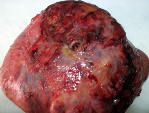 SOLITARY FIBROUS LIVER TUMOR