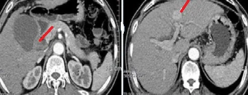 SYNCHRONOUS PRIMARY GALLBLADDER AND LIVER CARCINOMAS