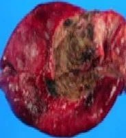 SYNCHRONOUS PRIMARY GALLBLADDER KAI LIVER CARCINOMAS