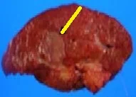 SYNCHRONOUS PRIMARY GALLBLADDER AND LIVER CARCINOMAS
