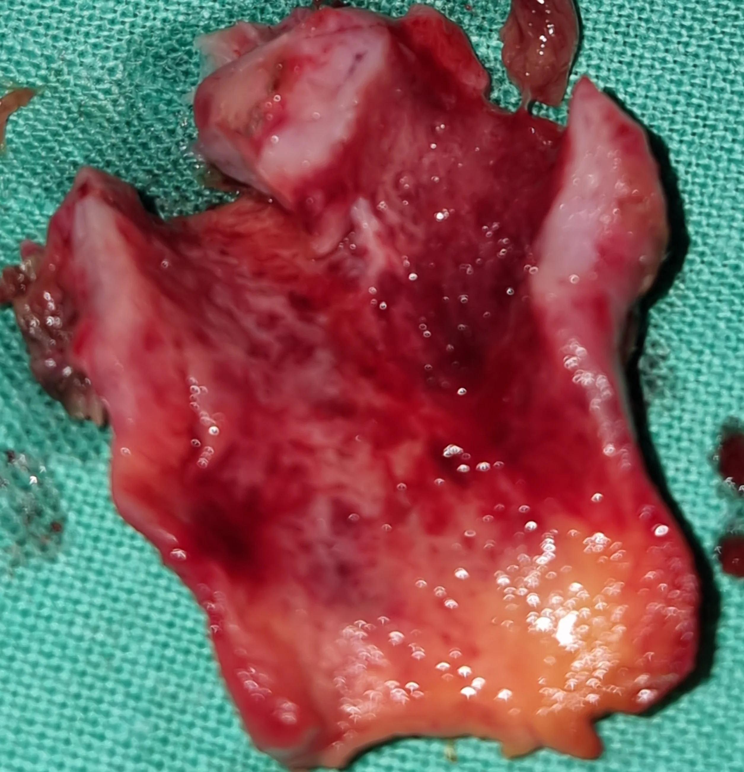 CHOLANGIOCARCINOMA