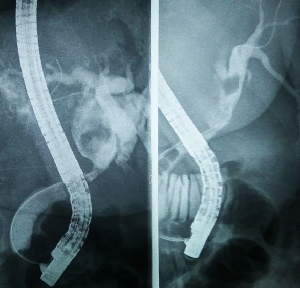 BILIARY LITHIASIS