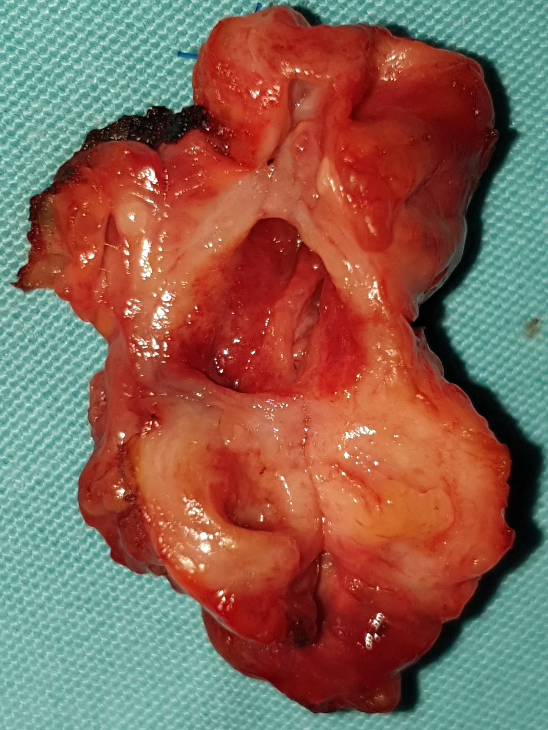 CHOLANGIOCARCINOMA