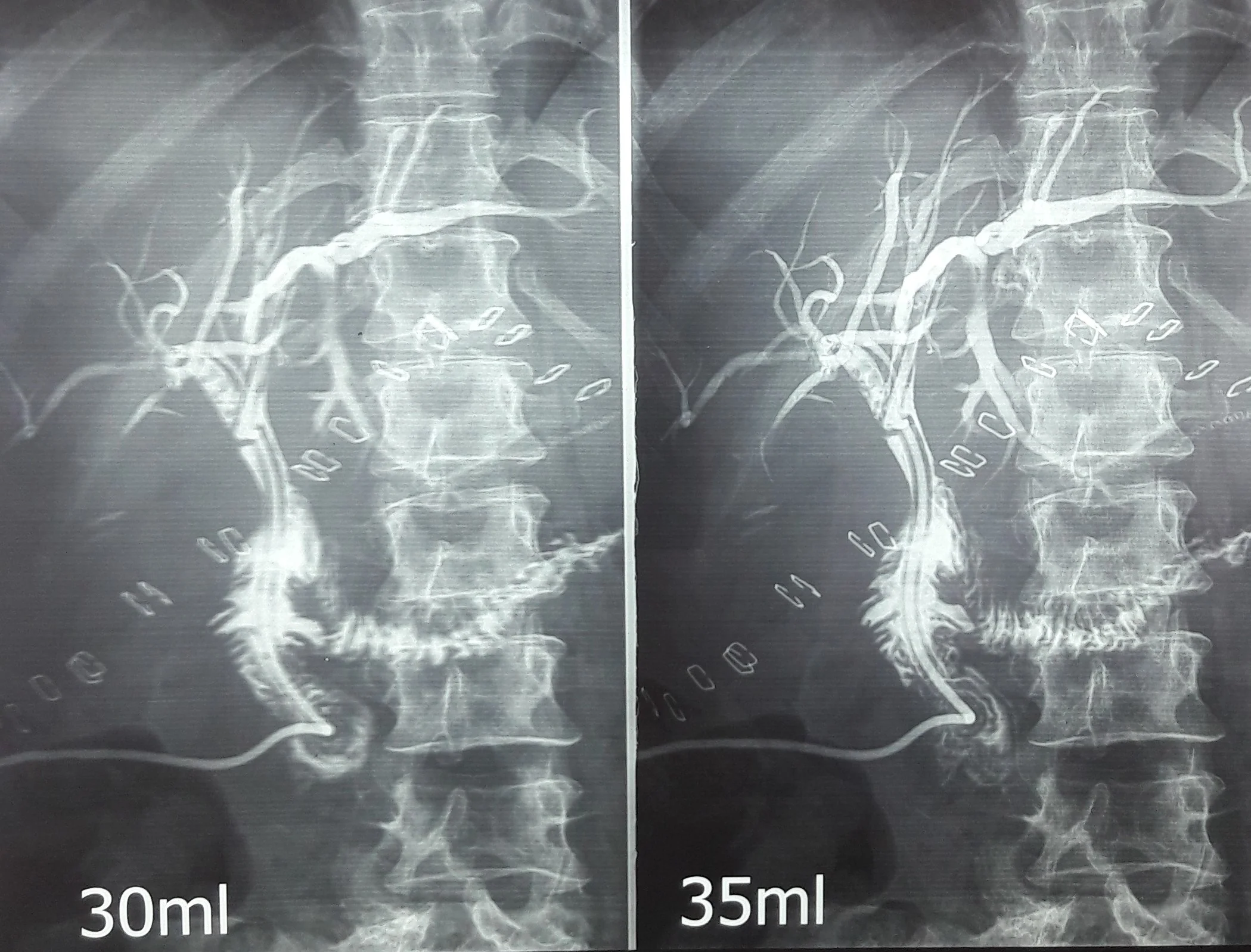 BILIO-ENTERIC ANASTOMOSIS