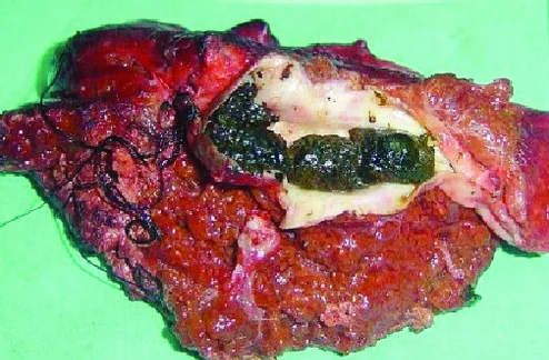 SOLITARY CYST