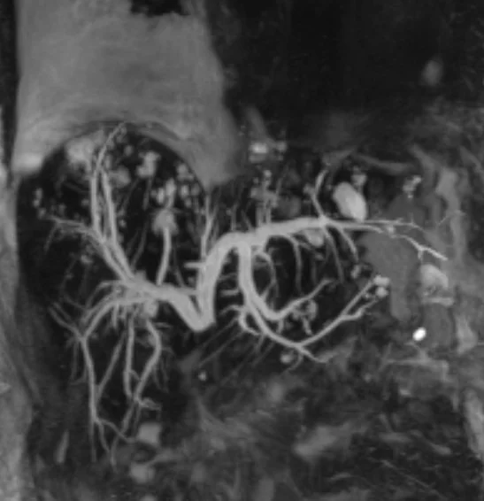 BILIOENTERIC ANASTOMOSIS OBSTRUCTION