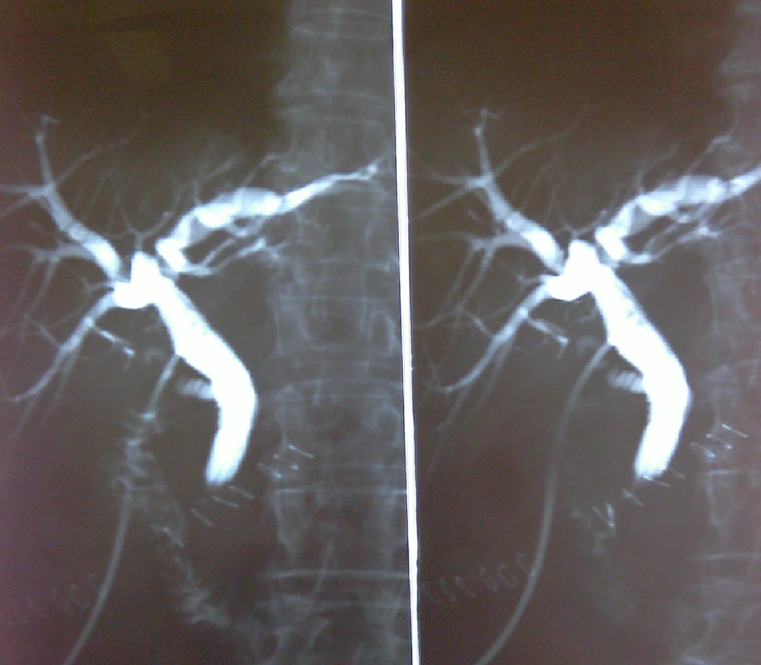 COMMON BILE DUCT ADENOMA