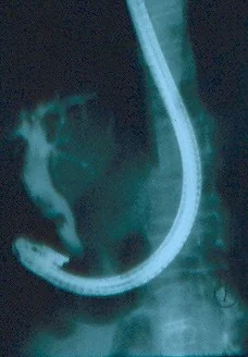 FAILED ERCP - RETROPERITONEAL DUODENAL RUPTURE