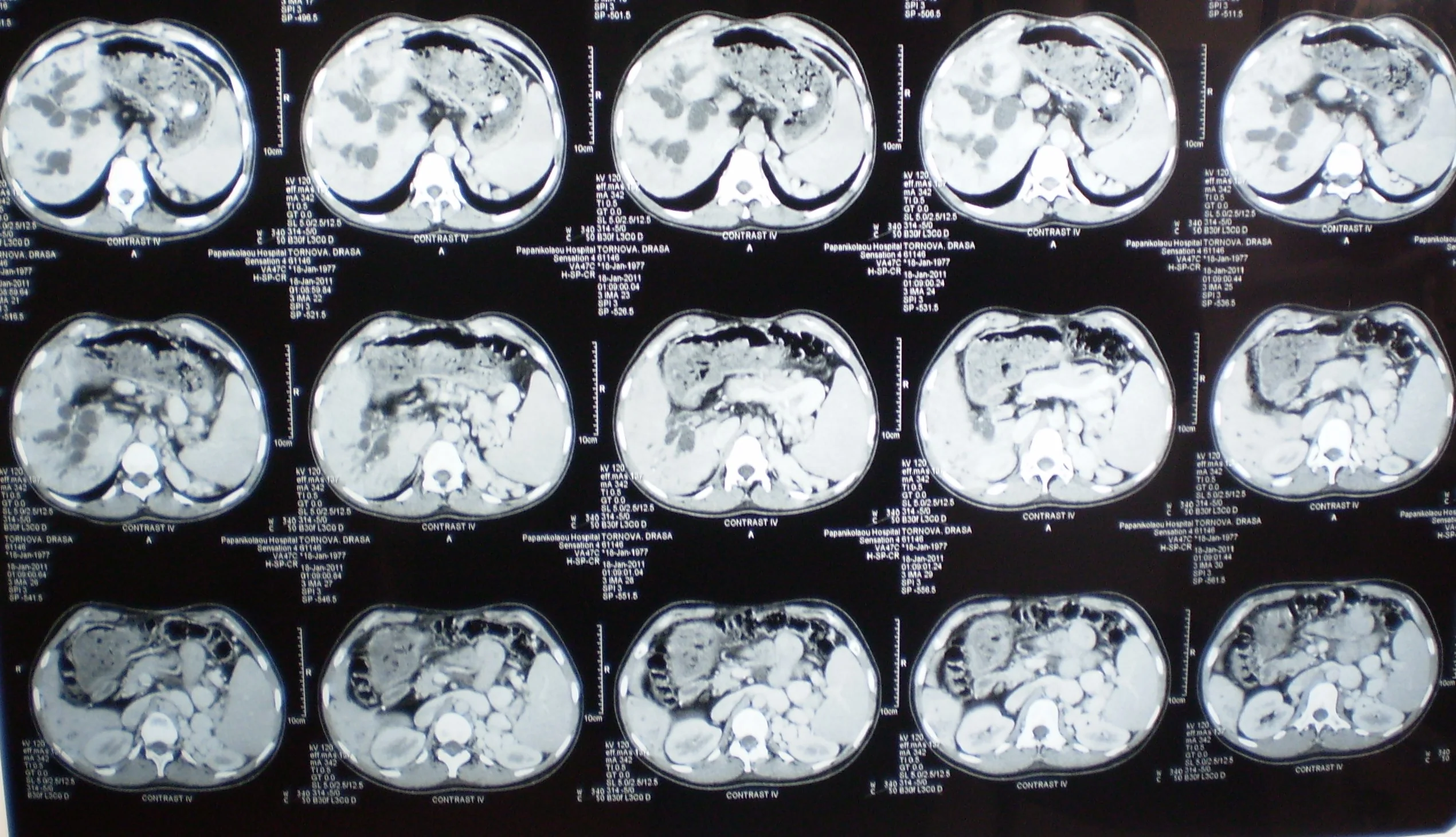 CAROLI'S DISEASE