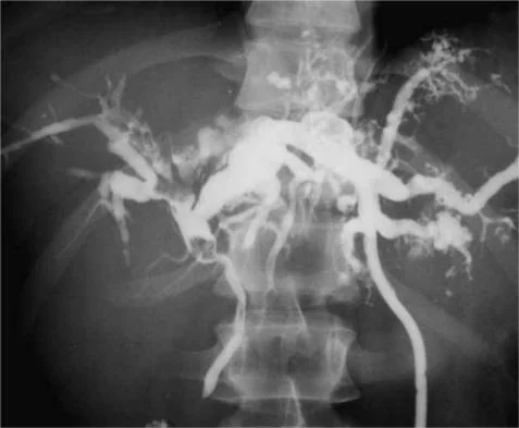 BILATERAL CAROLI'S DISEASE