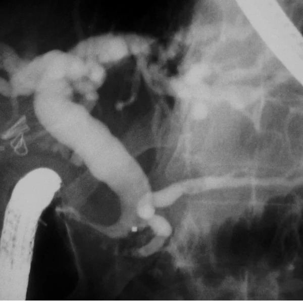 COMMON BILE DUCT STRICTURE
