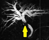 CHOLANGIOCARCINOMA