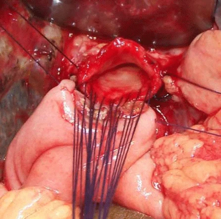 BILIOENTERIC ANASTOMOSIS
