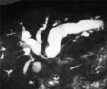 CHOLANGIOCARCINOMA