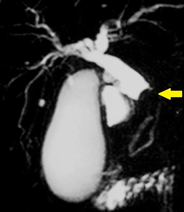 CHOLANGIOCARCINOMA