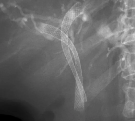 CHOLANGIOCARCINOMA - STENTS INSERTION