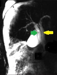 COMMON BILE DUCT DUPLICATION 