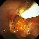 COMMON BILE DUCT STONE