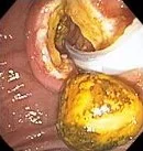 COMMON BILE DUCT STONES