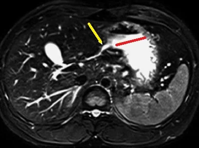 CONGENITAL LEFT HEPATIC DUCT DRAINING INTO THE STOMACH