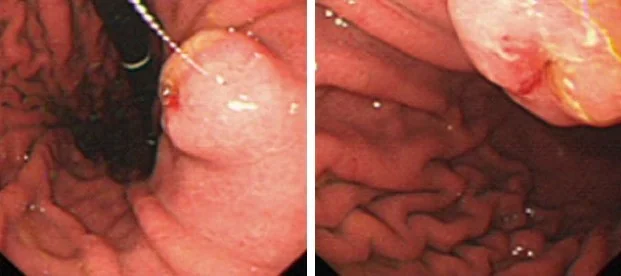 CONGENITAL LEFT HEPATIC DUCT DRAINING INTO THE STOMACH