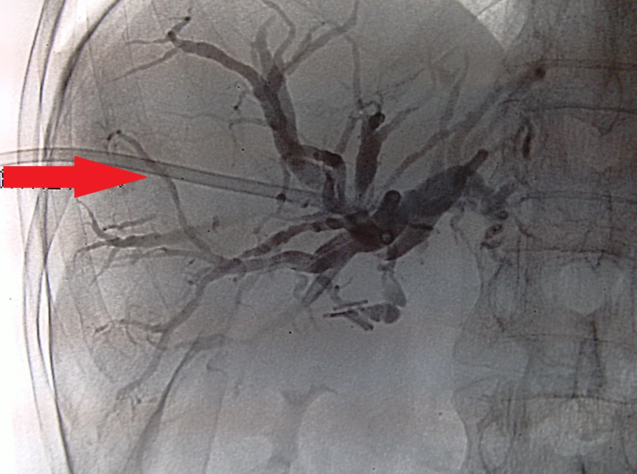 PERCUTANEOUS DRAINAGE