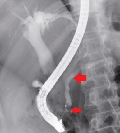 DILATATION COMMON BILE DUCT - AIR IN THE PANCREATIC DUCT
