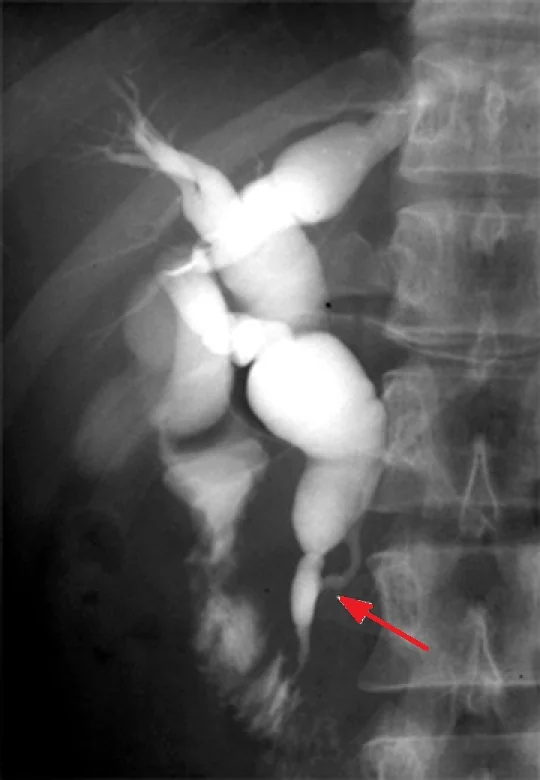 DILATATION COMMON BILE DUCT