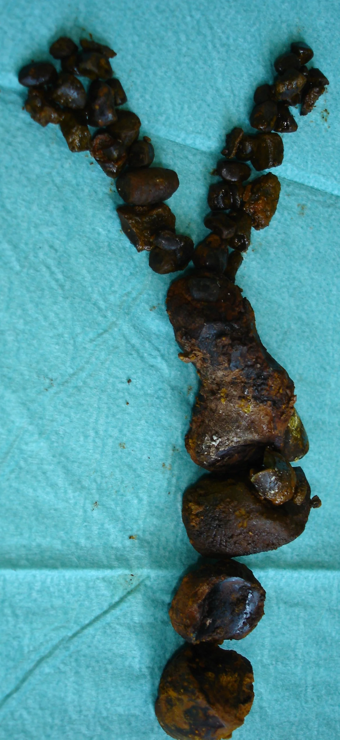 BILIARY STONES
